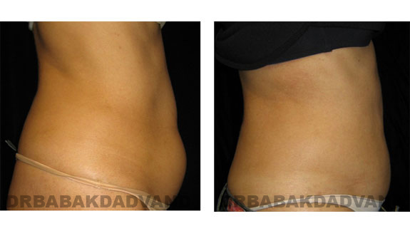 Before and After Photos |Liposuction| 55 year old woman, - right side view