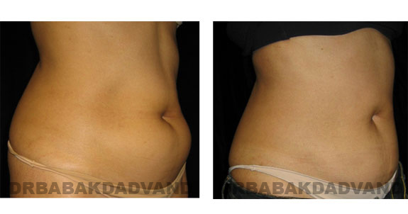 Before and After Photos |Liposuction| 55 year old woman, - right side, oblique view