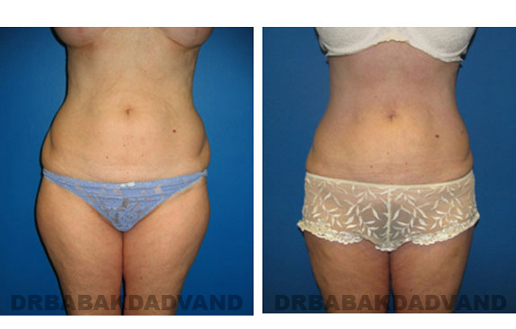 Before and After Photos |Liposuction| 47 year old woman, - front view