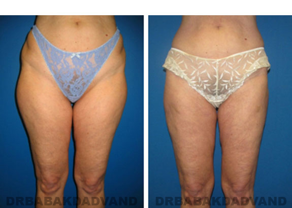 Before and After Photos |Liposuction| 47 year old woman, - front view (legs, tummy)