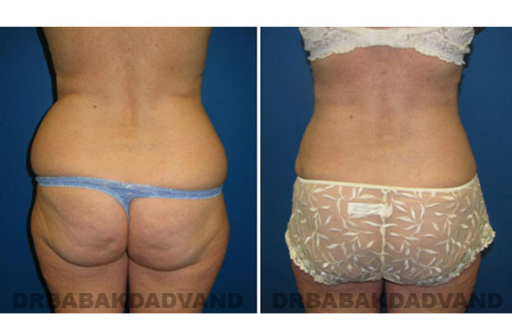 Before and After Photos |Liposuction| 47 year old woman, - back view