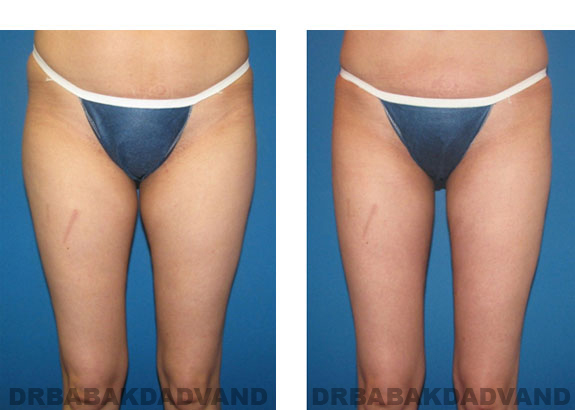 Before and After Photos |Liposuction| 34 year old woman, - front view