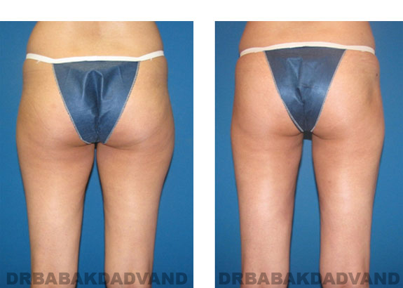 Before and After Photos |Liposuction| 34 year old woman, - back view