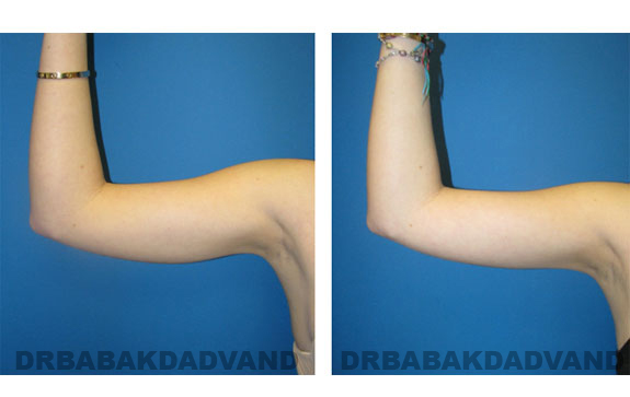 Before & After Photos |Liposuction| 22 year old woman, - front view (right hand)