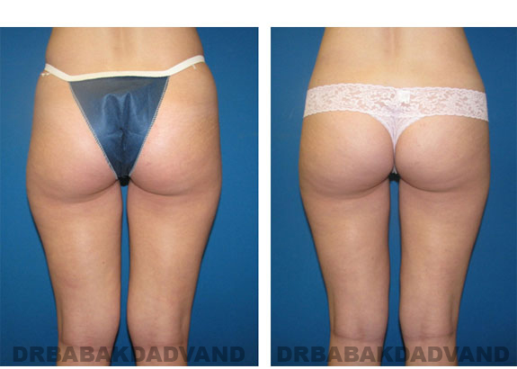 Before & After Photos |Liposuction| 22 year old woman, - back view