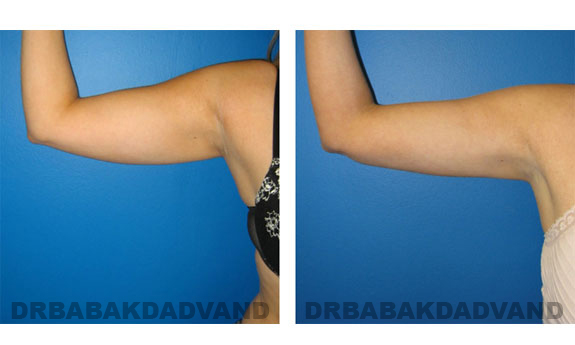 Before & After Photos |Liposuction| 26 year old woman, - front view (right hand)