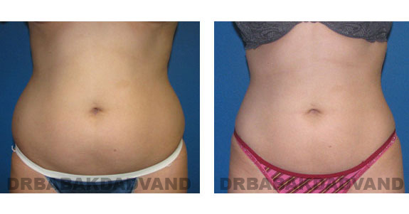 Before - After Photos |Liposuction| 28 year old woman, - front view