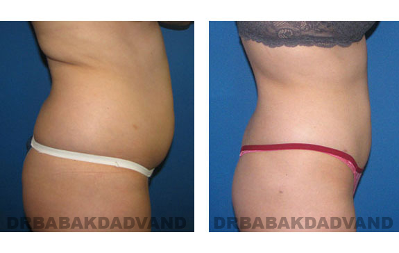 Before - After Photos |Liposuction| 28 year old woman, - right side view