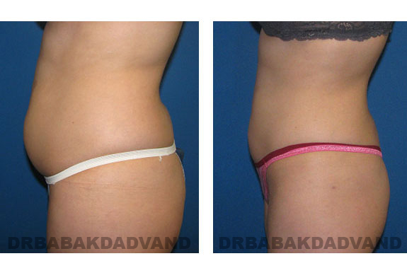 Before - After Photos |Liposuction| 28 year old woman, - left side view