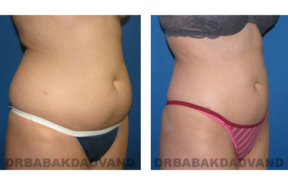Before - After Photos |Liposuction| 28 year old woman, - right side, oblique view