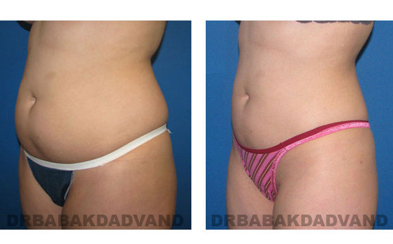 Before - After Photos |Liposuction| 28 year old woman, - left side, oblique view