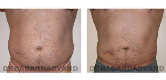 Before - After Photos |Liposuction| 39 year old man, - front view