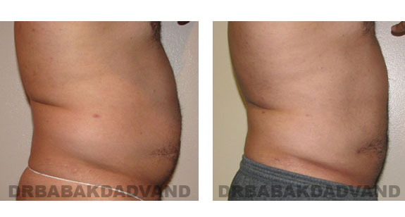 Before - After Photos |Liposuction| 39 year old man, - right side view