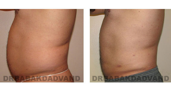 Before - After Photos |Liposuction| 39 year old man, - left side view