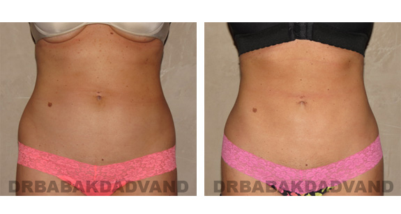 Before and After Photos |Liposuction| 30 year old woman, - front view
