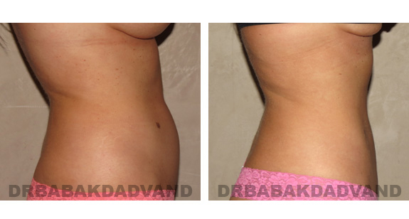 Before and After Photos |Liposuction| 30 year old woman, - right side view