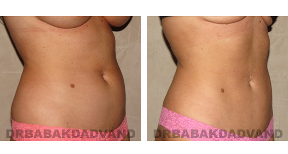 Before and After Photos |Liposuction| 30 year old woman, - right side, oblique view