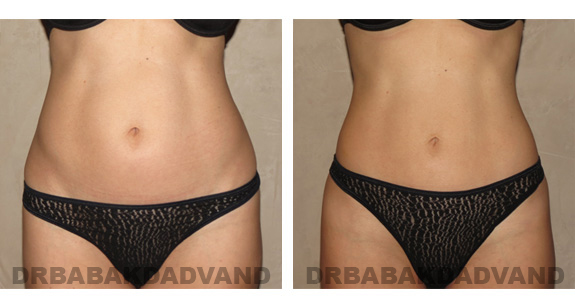Before and After Photos |Liposuction| 40 year old woman, - front view