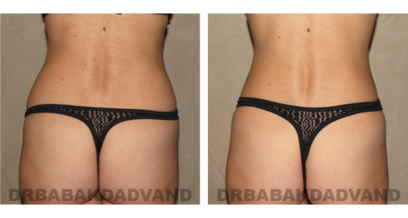 Before and After Photos |Liposuction| 40 year old woman, - back view
