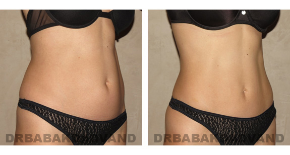Before and After Photos |Liposuction| 40 year old woman, - right side, oblique view