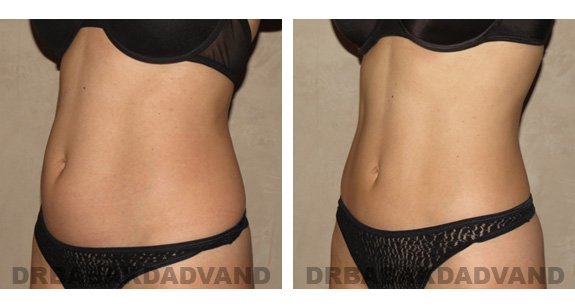 Before and After Photos |Liposuction| 40 year old woman, - left side, oblique view