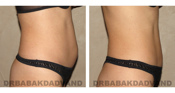 Before and After Photos |Liposuction| 40 year old woman, - right side view