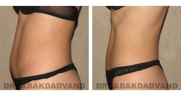 Before and After Photos |Liposuction| 40 year old woman, - left side view