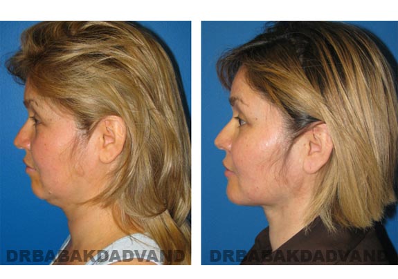 Before - After Photos |Necklift| 39 year old female, - left side view