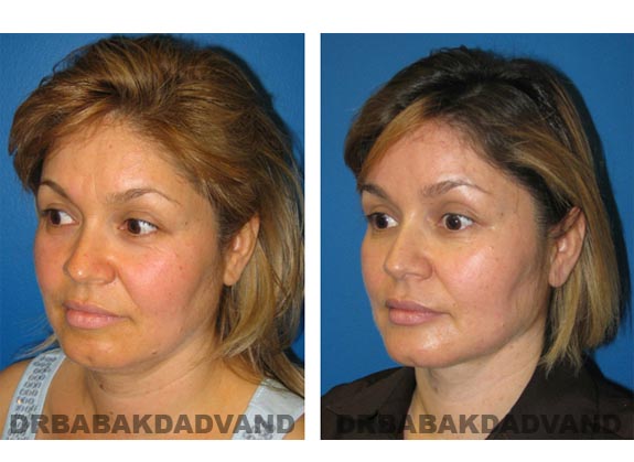 Before - After Photos |Necklift| 39 year old female, - left side,oblique view