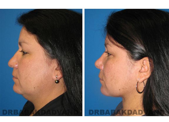 Before - After Photos |Necklift| 42 year old female, - left side view
