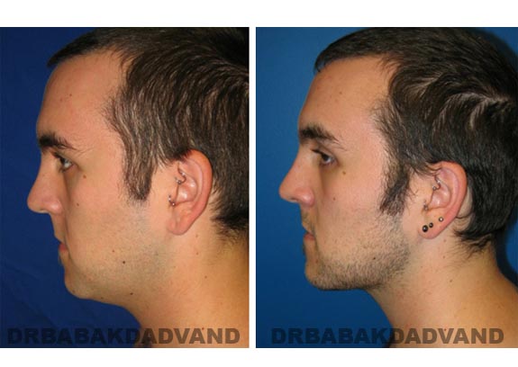 Before - After Photos |Necklift| 26 year old male, - left side view