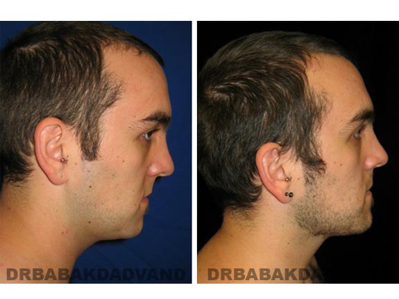 Before - After Photos |Necklift| 26 year old male, - right side view
