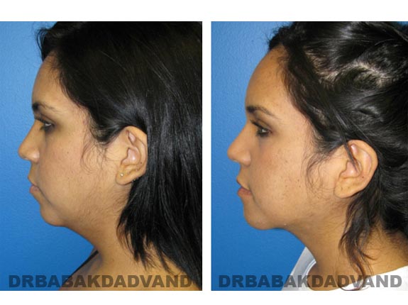 Before - After Photos |Necklift| 20 year old female, - left side view