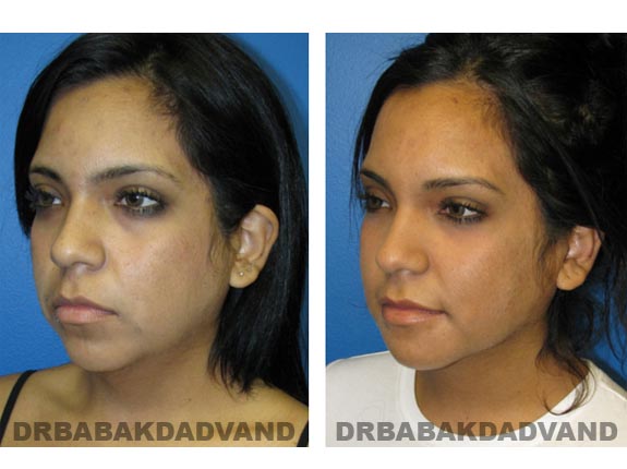 Before - After Photos |Necklift| 20 year old female, - left side,oblique view
