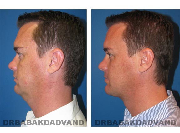 Before - After Photos |Necklift| 37 year old male, - left side view