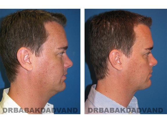 Before - After Photos |Necklift| 37 year old male, - right side view