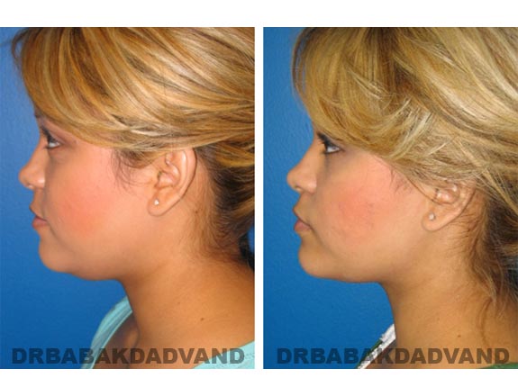 Before - After Photos |Necklift| 23 year old female, - left side view
