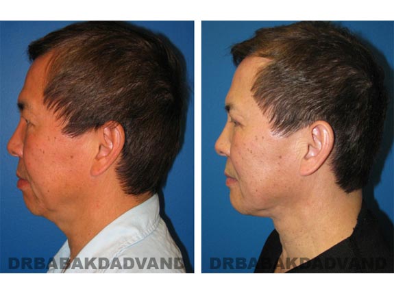 Before - After Photos |Necklift| 57 year old male, - left side view