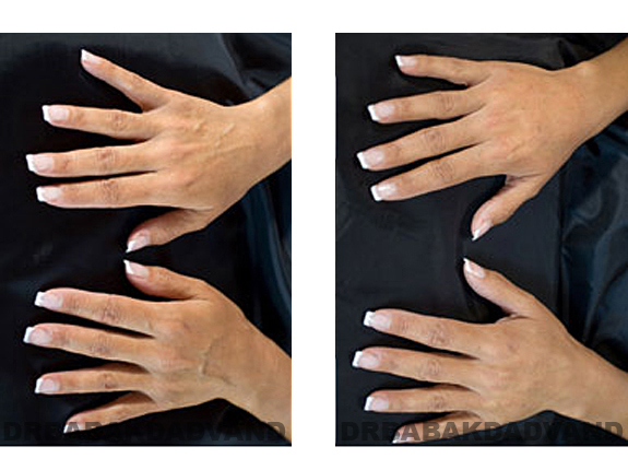 Before and After Photos |Radiesse| female (hands)
