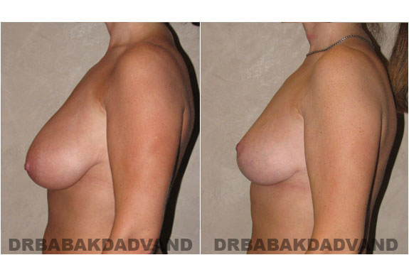 Before and After Photos. Breast-Reduction: - 43 year old female, left side view