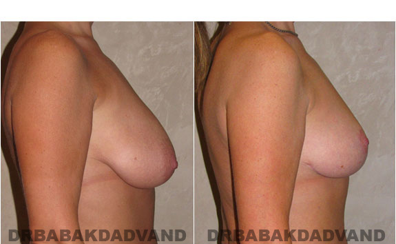 Before and After Photos. Breast-Reduction: - 43 year old female, right side view