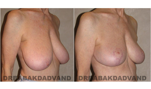 Before and After Photos. Breast-Reduction: - 62 year old female, right side, oblique view
