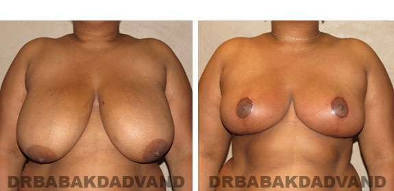 Before and After Photos. Breast-Reduction: - 36 year old female, front view