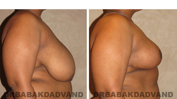 Before and After Photos. Breast-Reduction: - 36 year old female, right side view