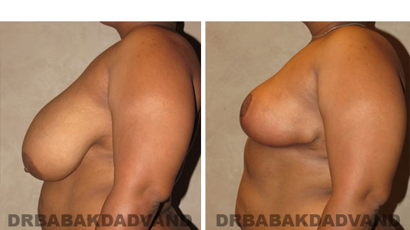 Before and After Photos. Breast-Reduction: - 36 year old female, left side view