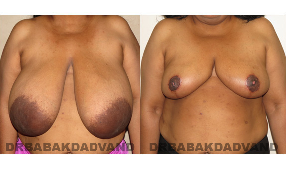 Before and After Photos. Breast-Reduction: - 54 year old female, front view