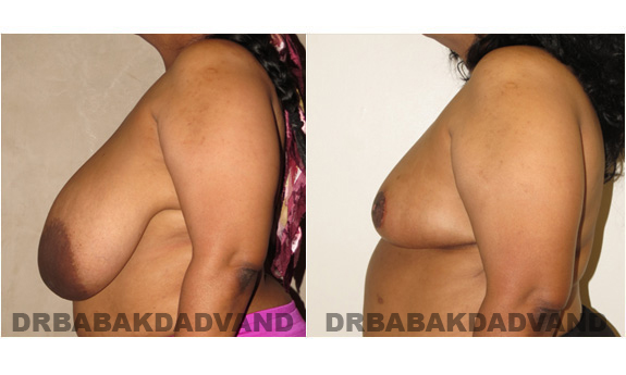 Before and After Photos. Breast-Reduction: - 54 year old female, left side view