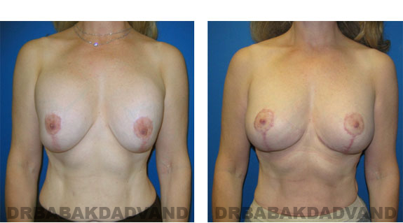 Before and After Photos |Revision Breast| - 53 year old female, - front view