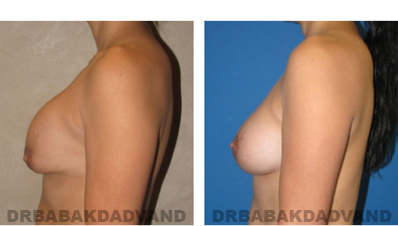 Before and After Photos |Revision Breast| - 36 year old female, - left side view
