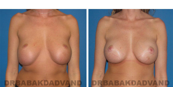 Before and After Photos |Revision Breast| - 27 year old female, - front view